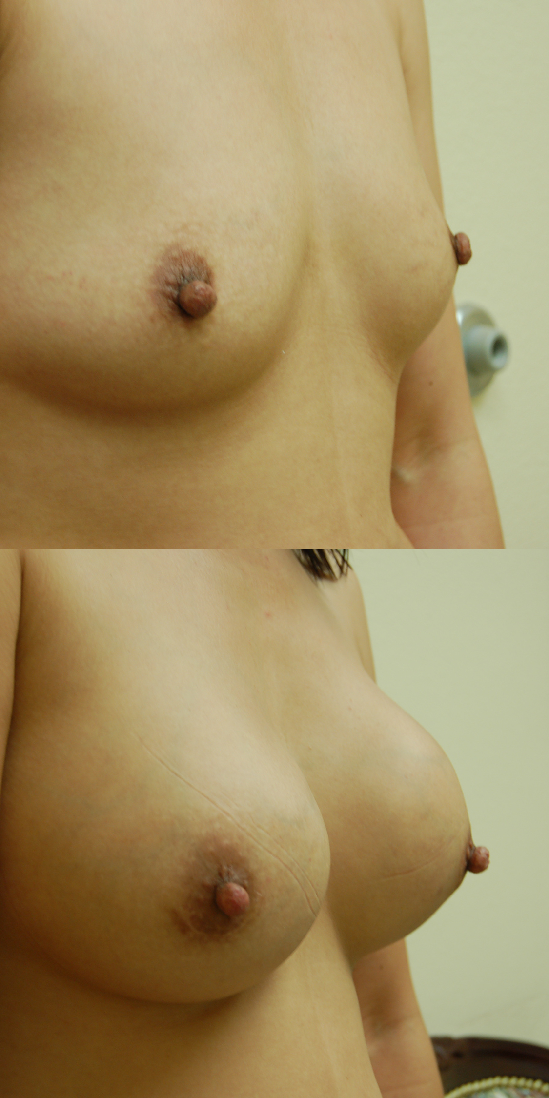 Breast Before & After​