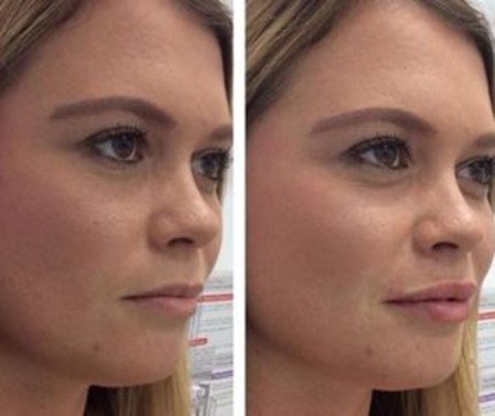 Lip fillers in San Jose: The different types of fillers Before and After