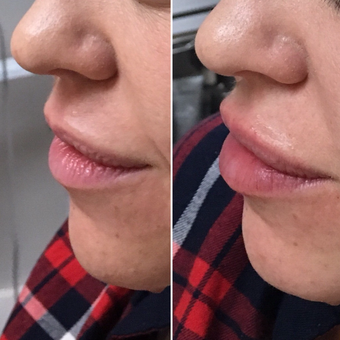 Restylane in San Jose: the best way to achieve fuller lips & a line-free face Before and After
