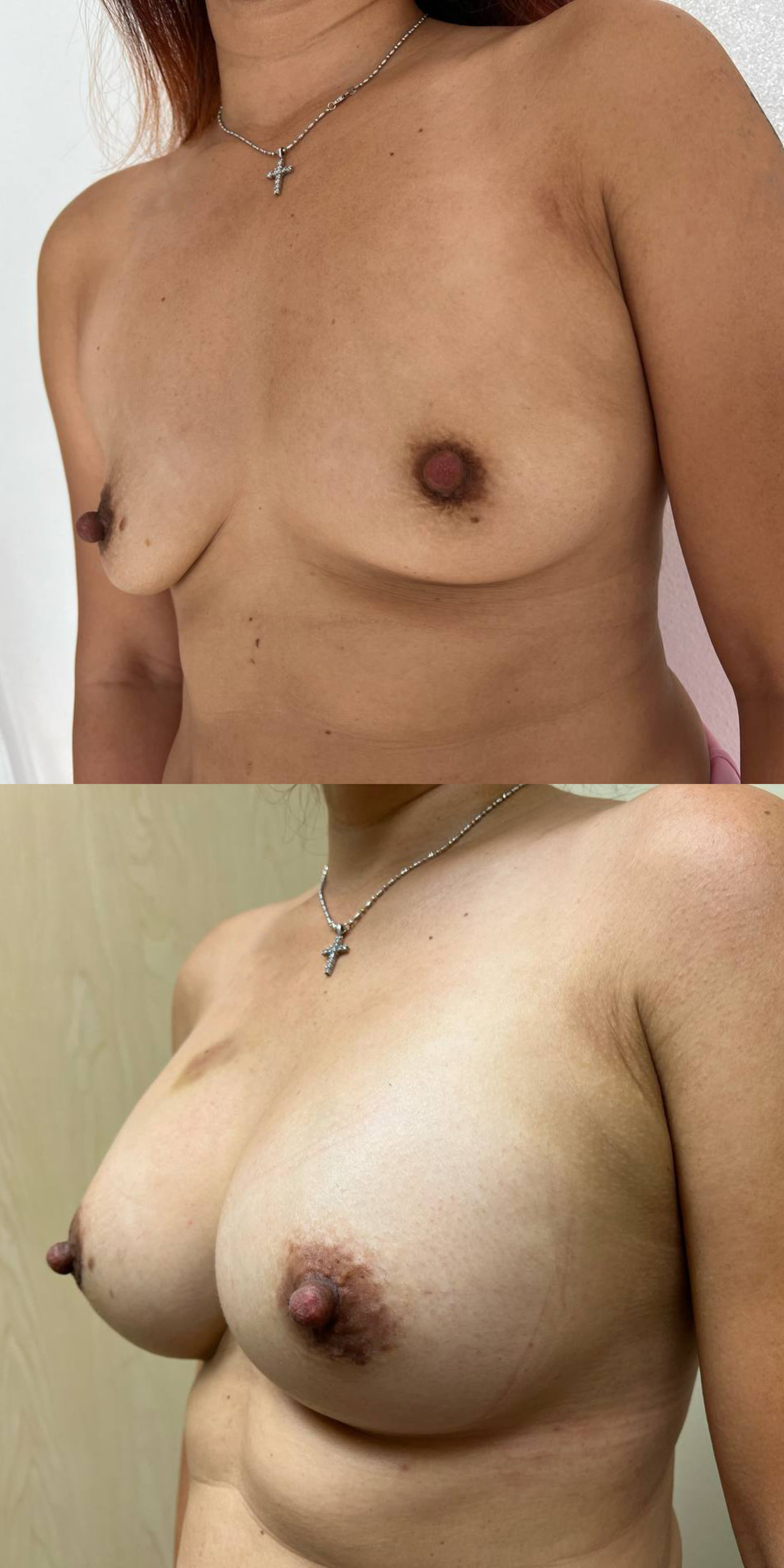 Before and After Image of Woman's Chest - Breast Implants